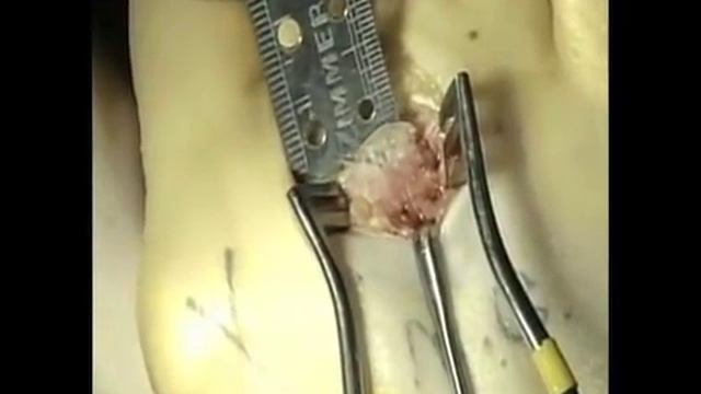 Weil остеотомия плюсневых костей смотреть онлайн