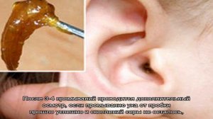 Промывка ушей от серных пробок