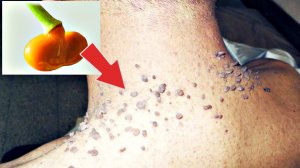 Помажьте этим папилломы и они отвалятся на глазах! Лучшие народные средства от папиллом