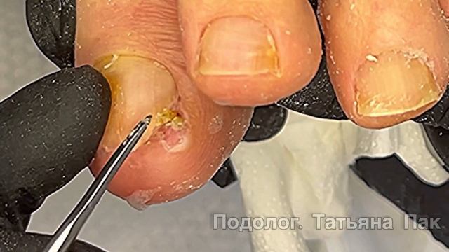 Большой палец согнулся под вторым | грибы | врос ноготь от давления кривых пальцев #подологмосква