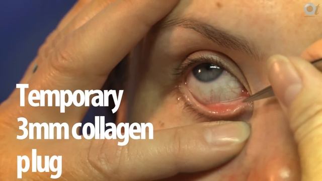 OT skills guide: punctum plugs смотреть онлайн