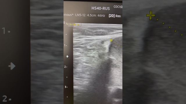 Тромб на ноге. Варикоз. Как лечить тромбоз. Флеболог Москва. Флеболог смотреть онлайн