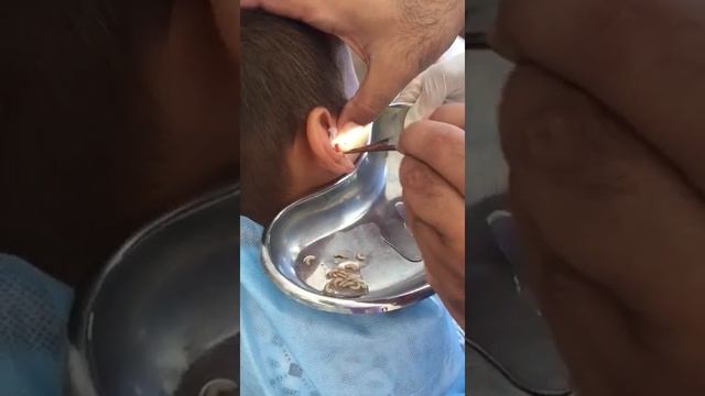 Черви (опарышы) в ушах у ребенка смотреть онлайн