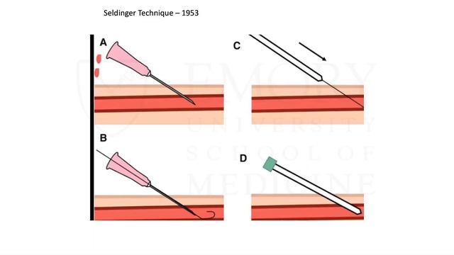The History of Catheterization of the Heart: From Self-Experimentation to Angioplasty смотреть онлайн
