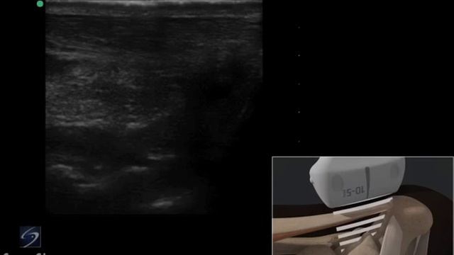 3D-пособие: ультразвуковое исследование ахиллова сухожилия — SonoSite смотреть онлайн