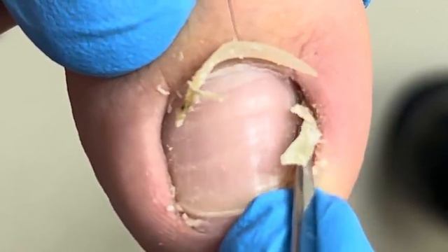 There are ingrown nails on both sides of the toenails, professional pedicure【Xue Yidao Pedicure】 смотреть онлайн