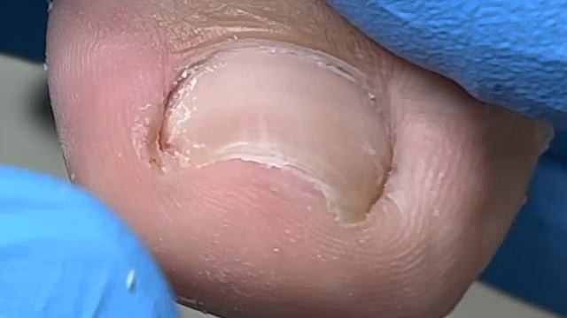 Twisted toenails, yellow ingrown toenails【Xue Yidao Pedicure】 смотреть онлайн