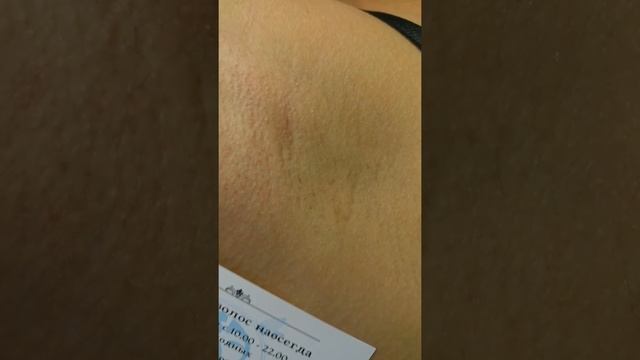 Электроэпиляция Спб смотреть онлайн