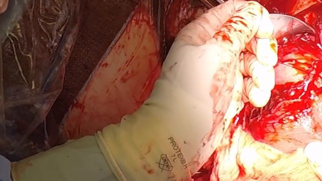 Cesarean Section; OBGYN Surgical Techniques with Dr. Kerry Campbell, MD смотреть онлайн
