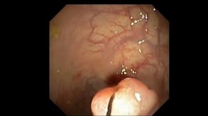 Удаление полипов прямой кишки эндоскопически