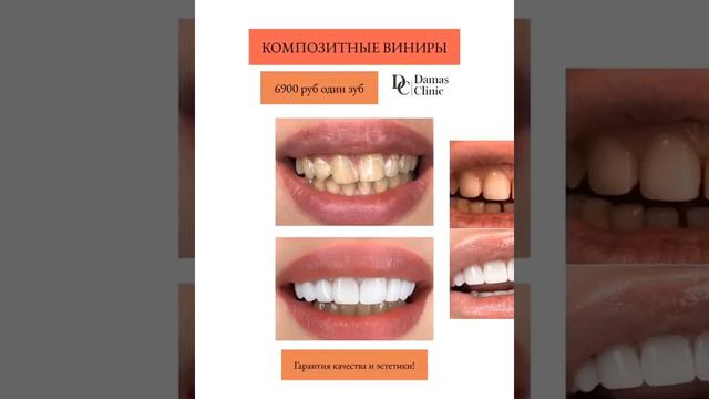 Композитные виниры: Результаты до и после смотреть онлайн