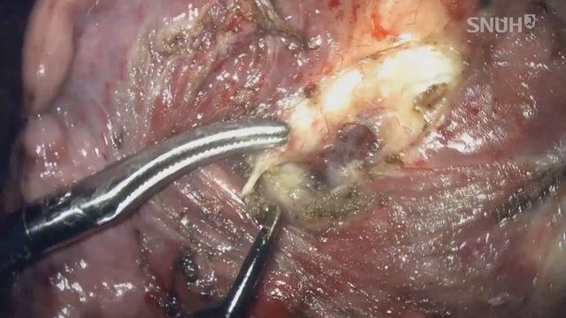 VATS LLLobectomy with mediastinal LN dissection смотреть онлайн