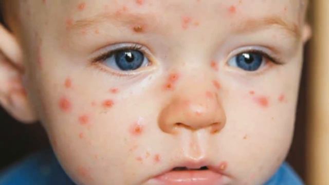 Suvchechak Tez Yuqadi ✵♔✵Сувчечак тез юқади