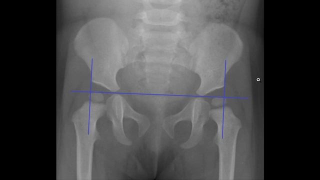 Дисплазия тазобедренного сустава: рентген? смотреть онлайн