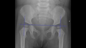 Дисплазия тазобедренного сустава: рентген?