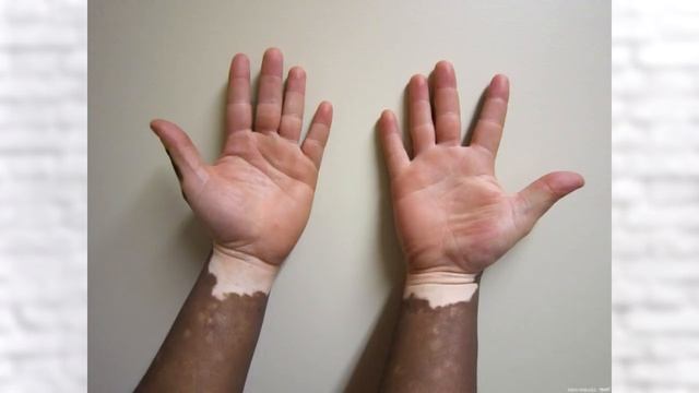 Вот что значат эти белые пятна на руке смотреть онлайн