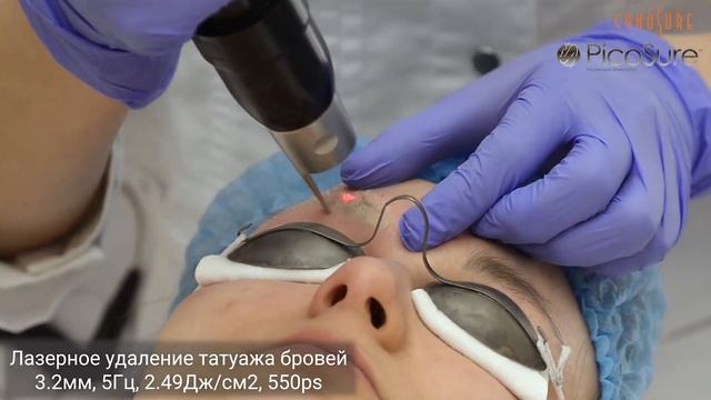 Лазерное удаление татуажа бровей смотреть онлайн