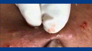 Выдавливание прыщей  2021- 13a.акне.акне.blackheads acne big