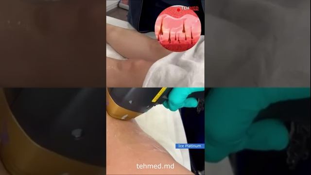 Диодный лазер для эпиляции Alma Soprano Ice Platinum video3 смотреть онлайн