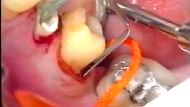 Отбеливание зубов, восковое моделирование