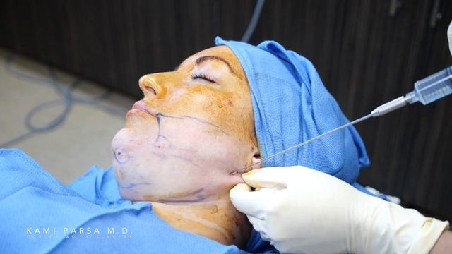 Embrace RF, Facetite + Morpheus 8 | Kami Parsa, M.D. Oculoplastic Surgeon | Beverly Hills CA смотреть онлайн