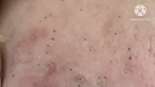 Super blackheads #HoangMySpa24 смотреть онлайн