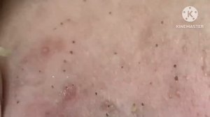 Super blackheads #HoangMySpa24