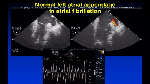 15-40 17-20 Cardiac Arrhythmias 2022 смотреть онлайн