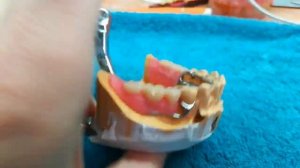 Шинирующий бюгельный протез