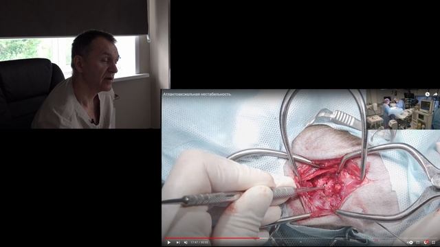 Атлантоаксиальная стабилизация смотреть онлайн