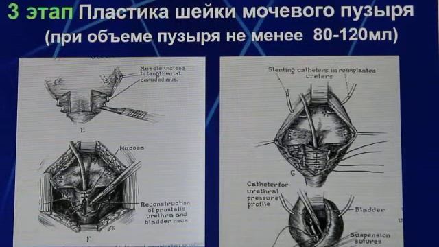 Первичное закрытие при экстрофии. Ю.Э. Рудин. смотреть онлайн