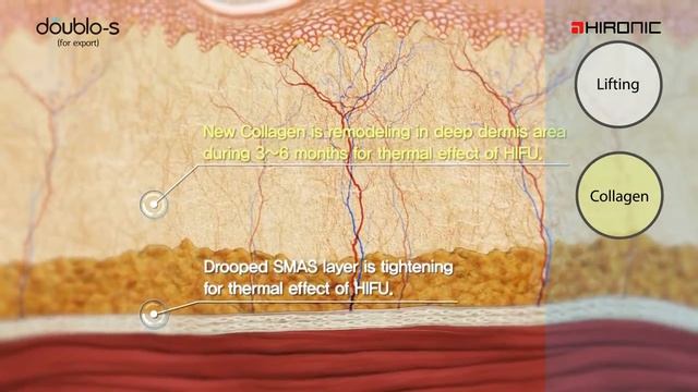Thiết bị thẩm mỹ BEMED - Cơ chế tác động vào da khi trị liệu Doublo - S | HIFU смотреть онлайн