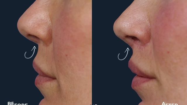 Lip Lift vs Lip Filler | Dr. David Stoker | Los Angeles, CA смотреть онлайн