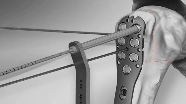 Proximal Humerus Fracture Repair with Arthrex® SuturePlate™ смотреть онлайн