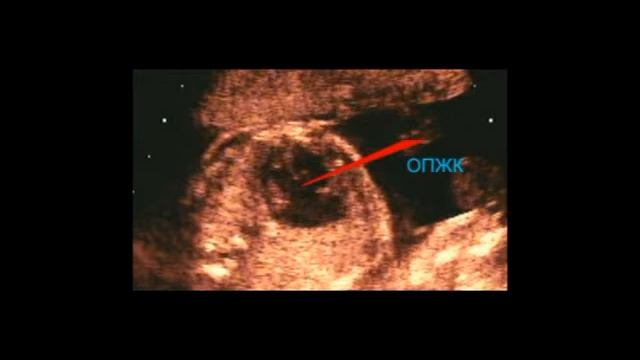 20. Общий предсердно - желудочковый канал у плода, часть 2 (Endocardial Cushion Defect in fetus) смотреть онлайн