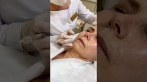 Бланширование кисетных морщин