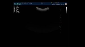 УЗИ надпочечников: техника исследования