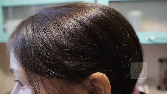 Перхоть сыпалась снегом сделала эту маску и все как рукой сняло! Как избавиться от перхоти? смотреть онлайн