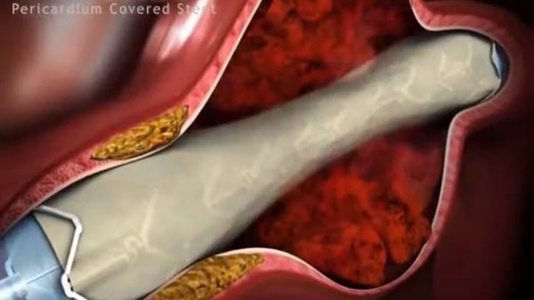 Aneu Graft Стент-графт