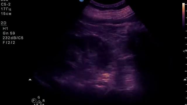 Копия видео "образование левой почки 2" смотреть онлайн