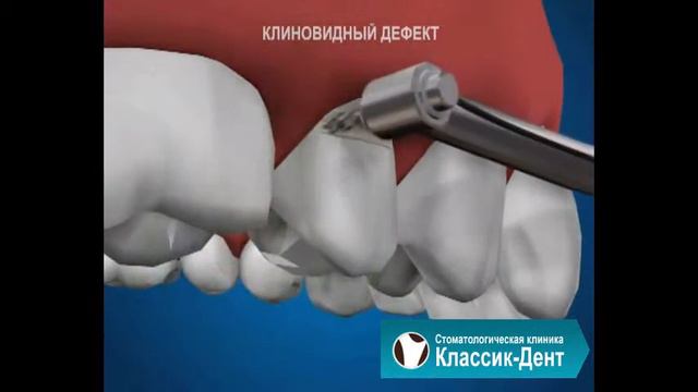 Классик-Дент: Клиновидный дефект смотреть онлайн