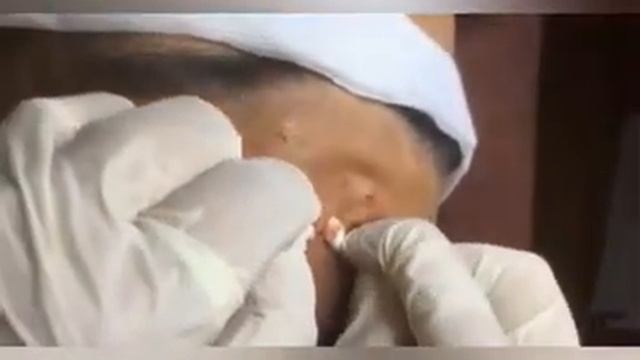 Давим прыщи с брызгами смотреть онлайн