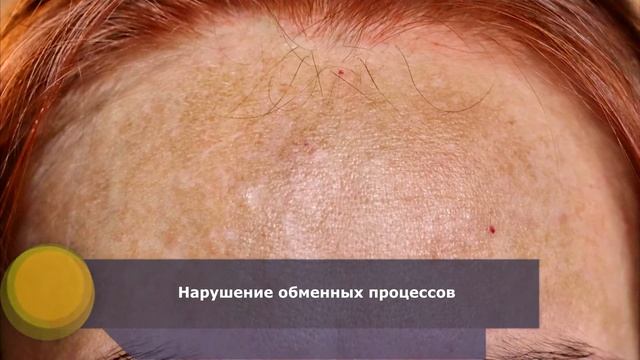 Причины пигментации кожи | Почему происходит пигментация кожи смотреть онлайн