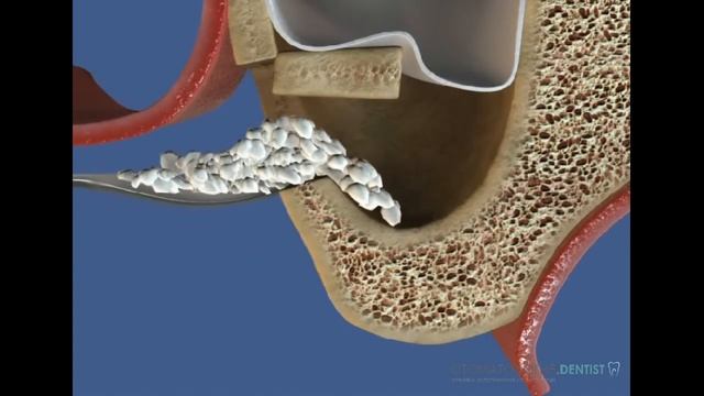 Костная пластика стоматология dentist смотреть онлайн