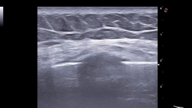 Перелом ребра, месяц после травмы смотреть онлайн