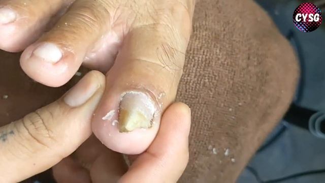 Pedicure Nails Ingrown Toenail // Педикюр Вросший Ноготь