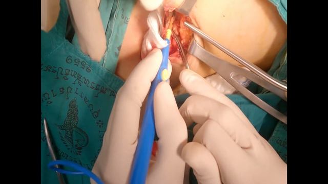 Axillary lymph node dissection смотреть онлайн