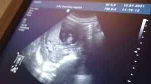 Я беременна!!!УЗИ на 12 неделе. Как выглядит малыш на УЗИ в 12 недель ❤️первый скрининг