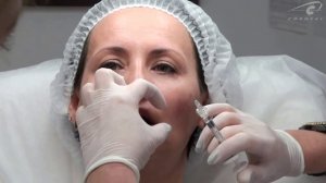 Губы без анестезии. Контурная пластика Princess-оналайн урок 'Корнеаль'.