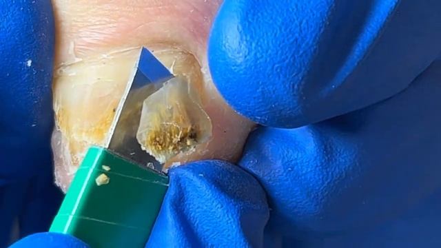 Pedicure Tutorial: Quick Trim For Thick Yellow Nails!【Xue Yidao Pedicure】